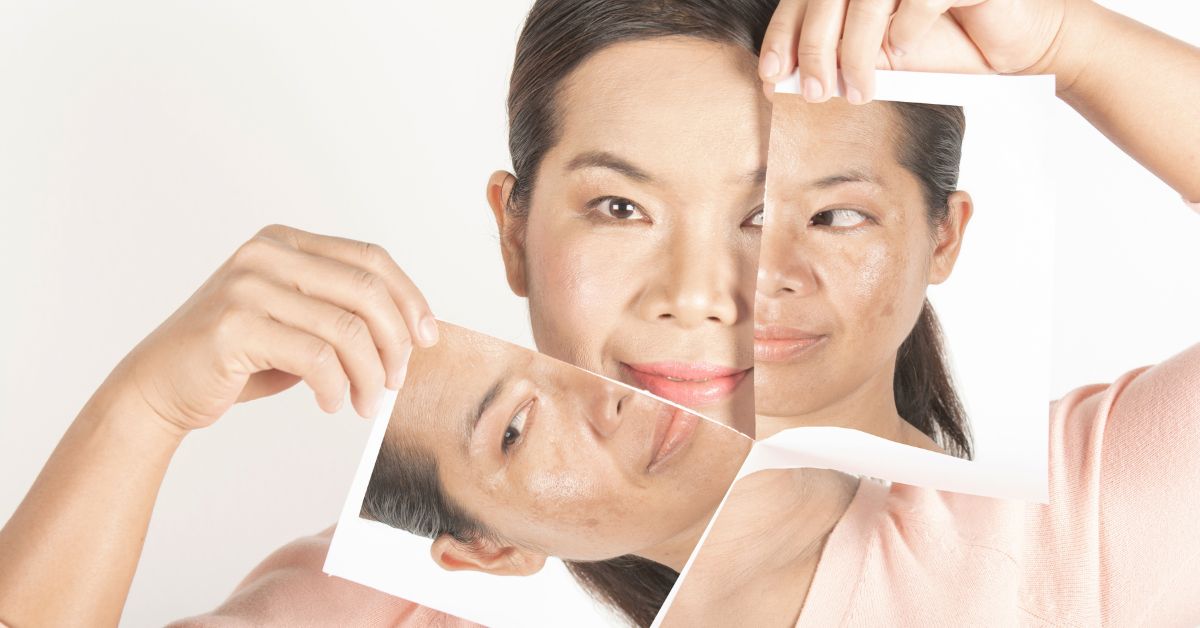 Does Vitamin C Help With Dark Spots Yes It Can Here s How Does Vitamin C Help With Dark Spots Yes It Can Here s How
