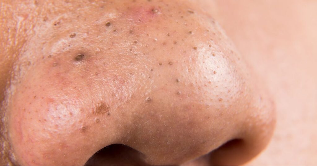 Is Panoxyl Good For Blackheads