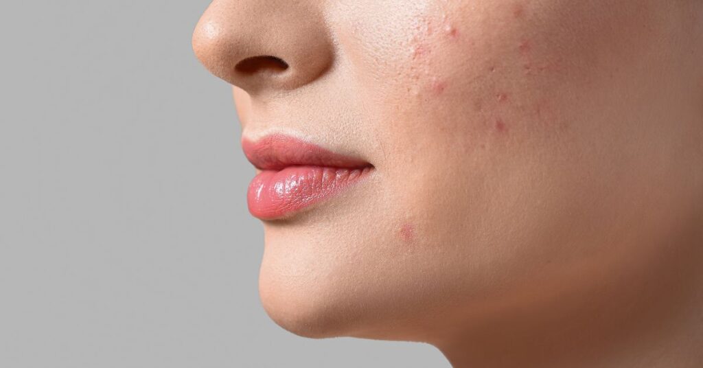 What Does Glycolic Acid Do For Acne